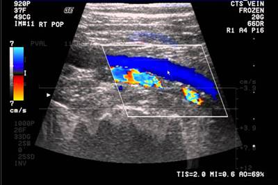 Ecografía Doppler color en Concepción