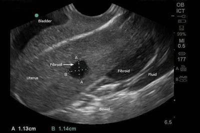 Ecografía Transvaginal en Concepción